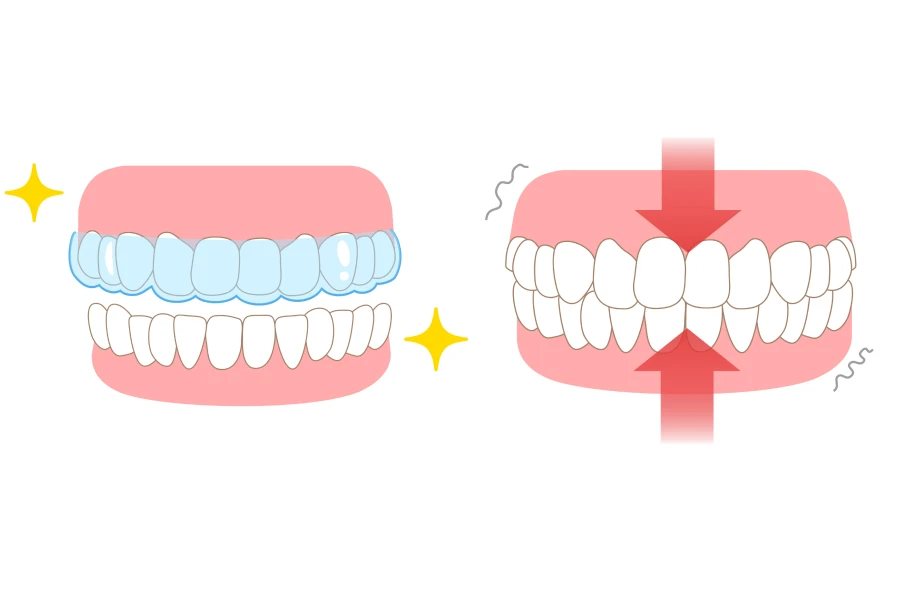 gouttiere bruxisme cabinet alti dent Gouttière bruxisme Cabinet dentaire Alti Dent