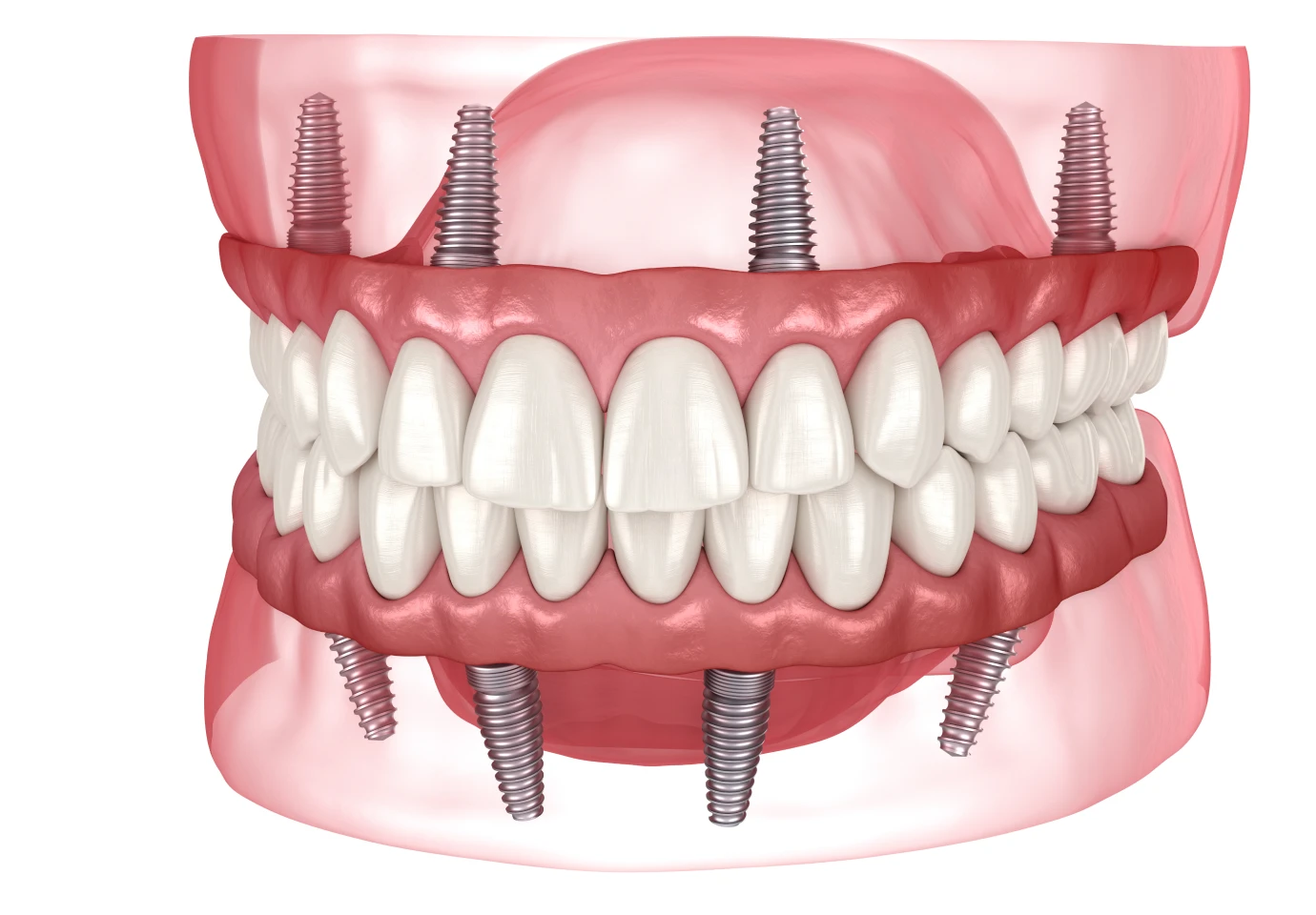 all on cabinet altitude All-on-4/6 Cabinet dentaire Alti Dent