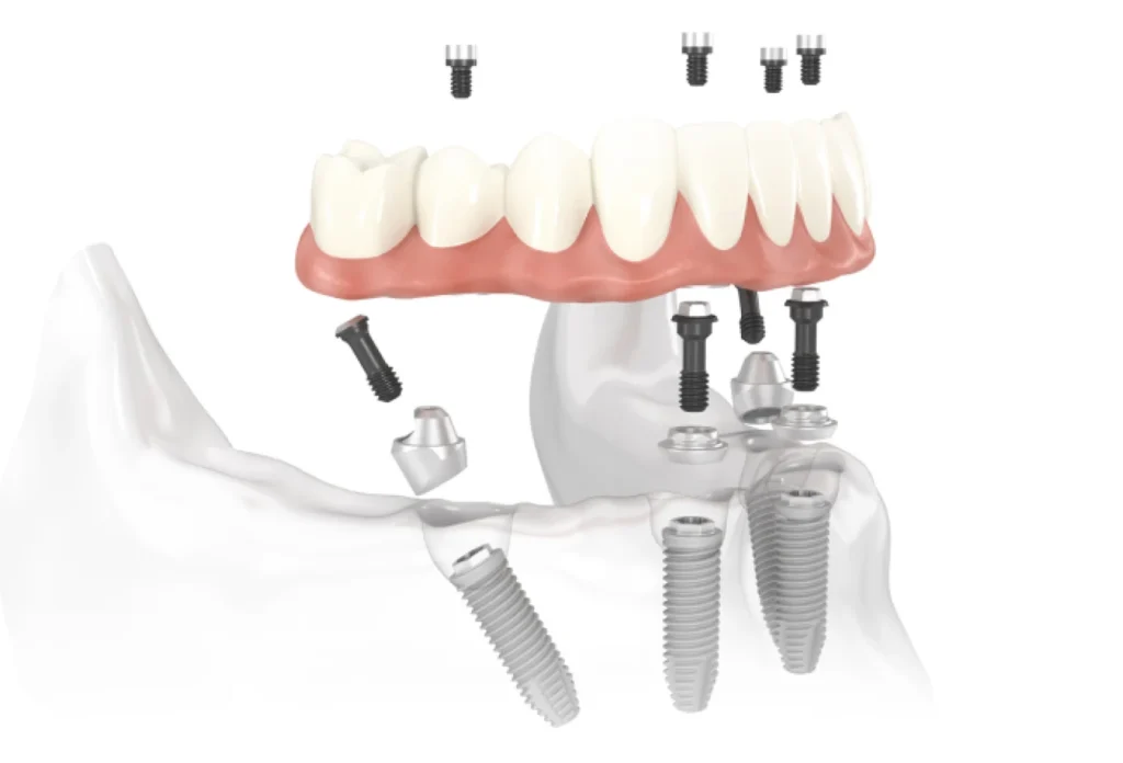 all on cabinet alti dent All-on-4/6 Cabinet dentaire Alti Dent