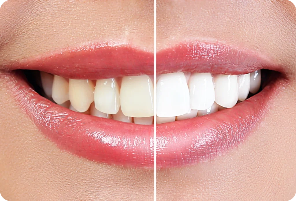 blanchiment dentaire cabinet alti dent Blanchiment dentaire Cabinet dentaire Alti Dent