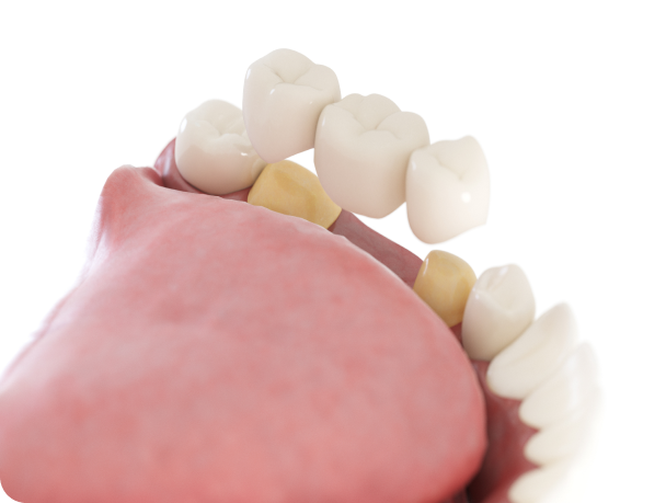 bridge dentaire dr lecomte Couronne céramique Cabinet dentaire Alti Dent