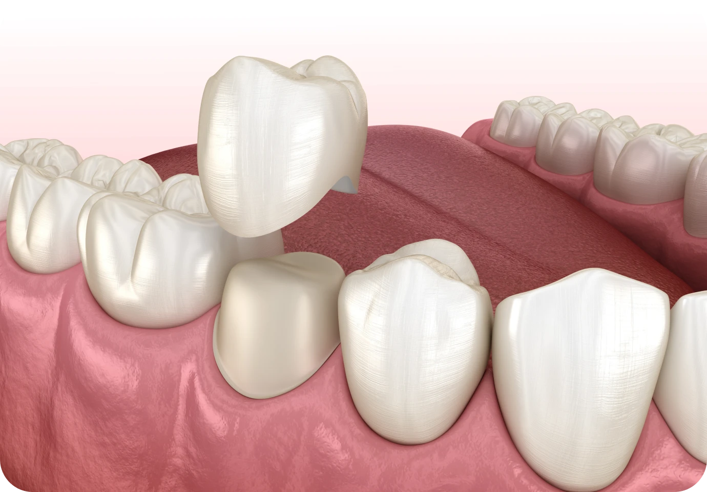 couronne ceramique alti dent Couronne céramique Cabinet dentaire Alti Dent