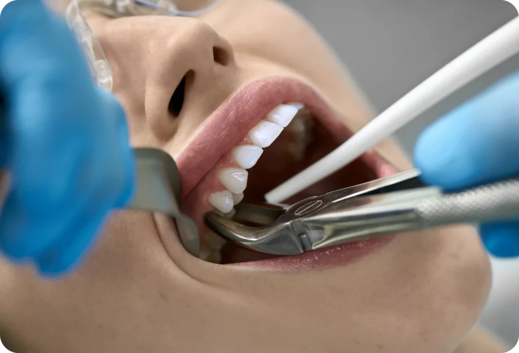 extraction implantation immediate alti dent eybens Extraction implantation immédiate Cabinet dentaire Alti Dent