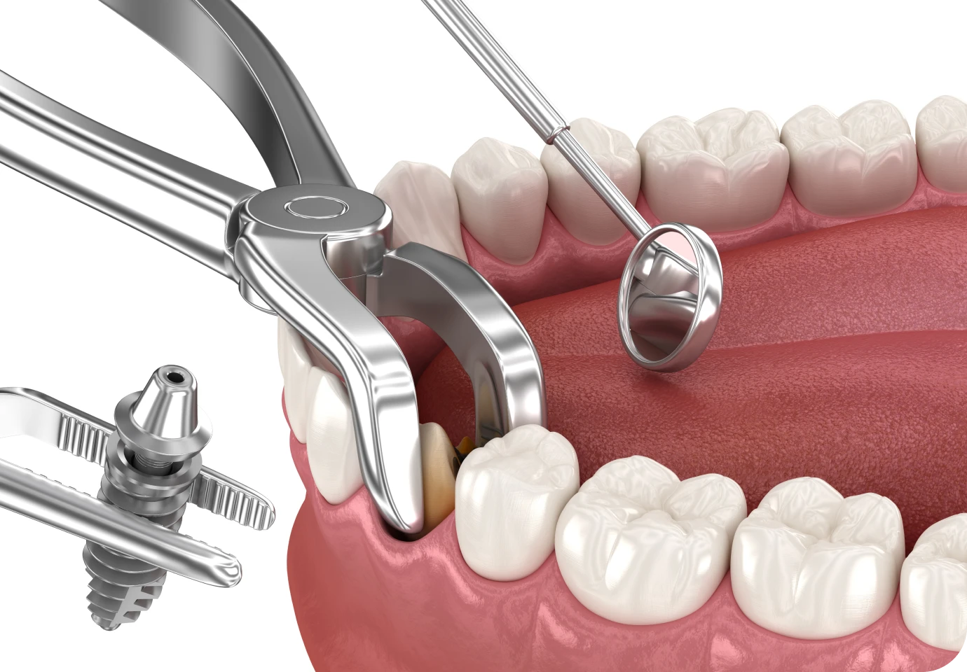 extraction implantation immediate alti dent Implant dentaire Cabinet dentaire Alti Dent