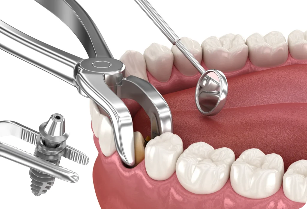 extraction implantation immediate cabinet alti dent Extraction implantation immédiate Cabinet dentaire Alti Dent