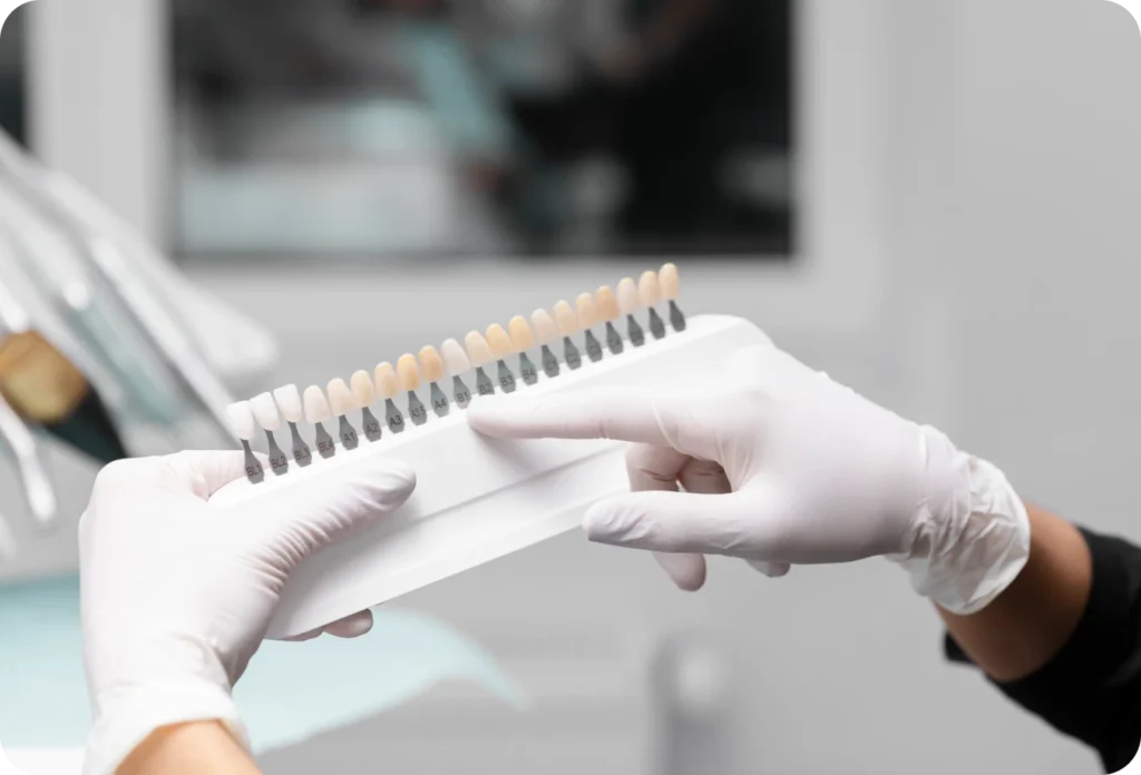 facettes dentaires cabinet alti dent Facettes dentaires Cabinet dentaire Alti Dent