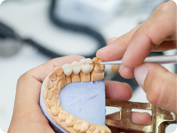 gouttiere protection eybens contact Prothèse mobile stabilisée sur implant Cabinet dentaire Alti Dent