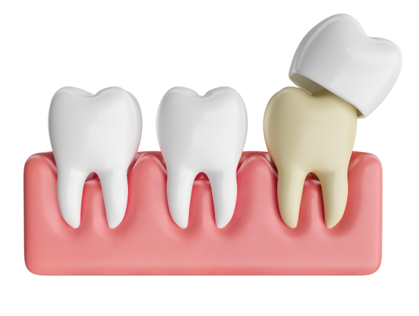 gouttiere protection eybens sport Inlay / Onlay Cabinet dentaire Alti Dent