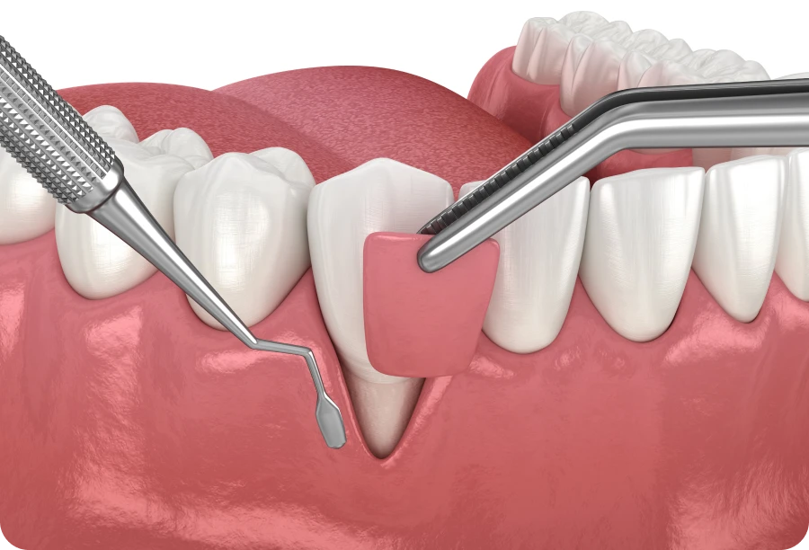 greffe gencive avant cabinet alti dent Greffe gingivale Cabinet dentaire Alti Dent