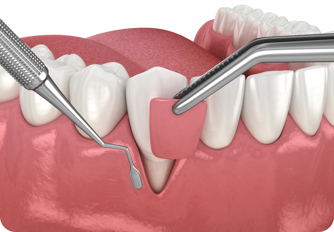 greffe gingivale alti dent Parodontologie chirurgicale Cabinet dentaire Alti Dent