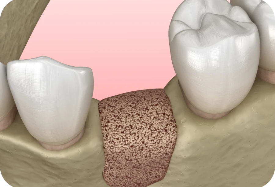 greffe osseuse cabinet alti dent eybens Greffe osseuse Cabinet dentaire Alti Dent