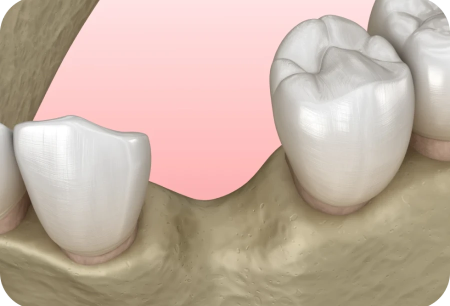 greffe osseuse cabinet alti dent Greffe osseuse Cabinet dentaire Alti Dent