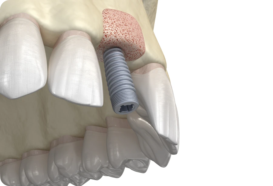 greffe osseuse docteur lecomte eybens Greffe osseuse Cabinet dentaire Alti Dent