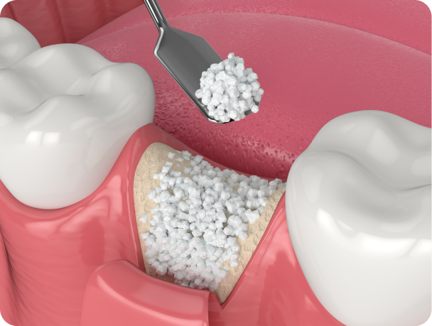 greffe osseuse lecomte Greffe osseuse Cabinet dentaire Alti Dent