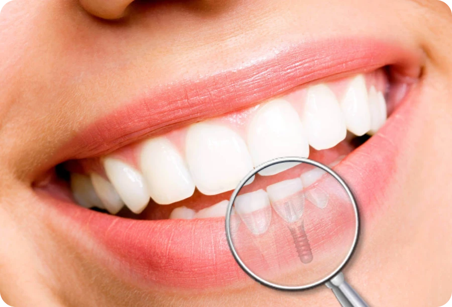 implant unitaire cabinet alti dent Implant dentaire Cabinet dentaire Alti Dent