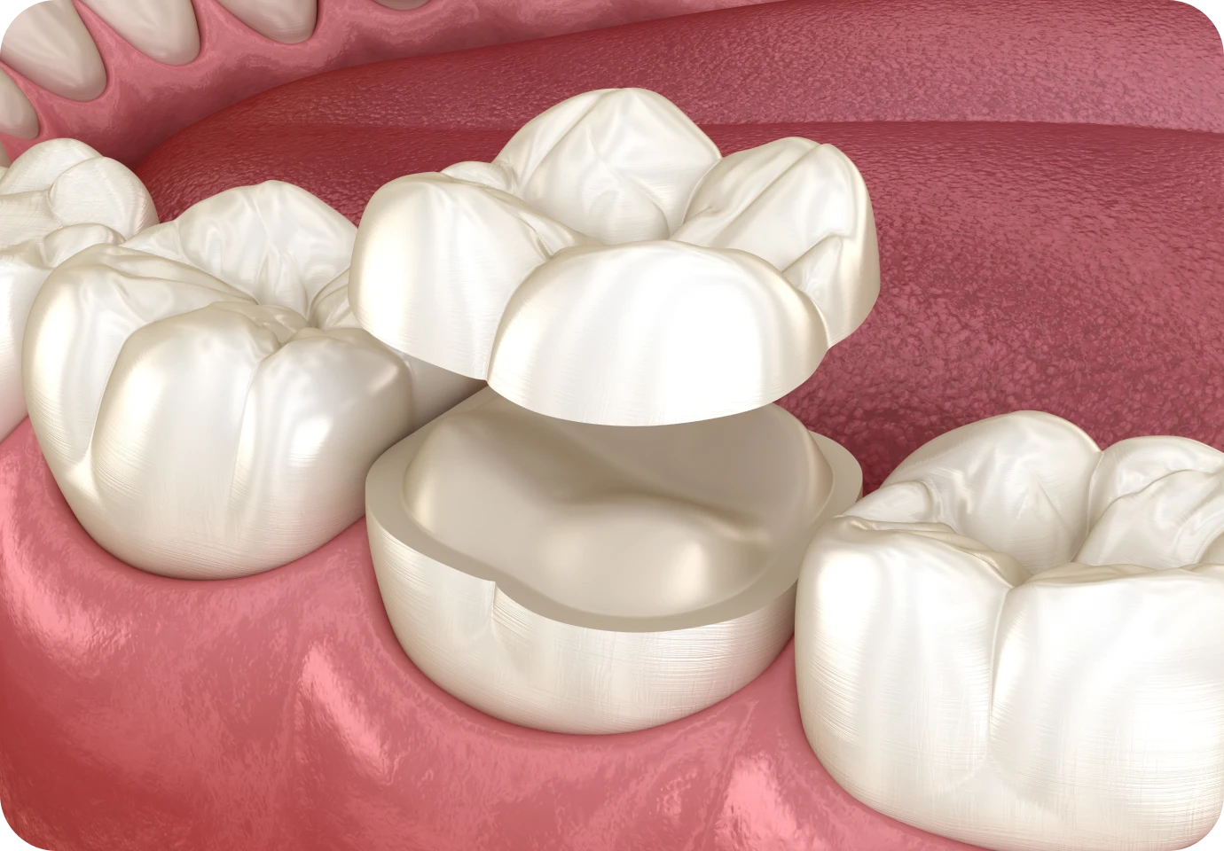 inlay onlay alti dent Inlay / Onlay Cabinet dentaire Alti Dent