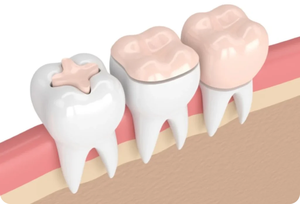 inlay onlay cabinet alti dent Inlay / Onlay Cabinet dentaire Alti Dent