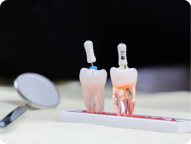 parodontologie clinique eybens expert Endodontie Cabinet dentaire Alti Dent