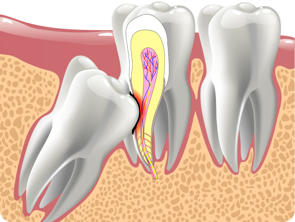 parodontologie clinique eybens suivi Extraction dentaire Cabinet dentaire Alti Dent
