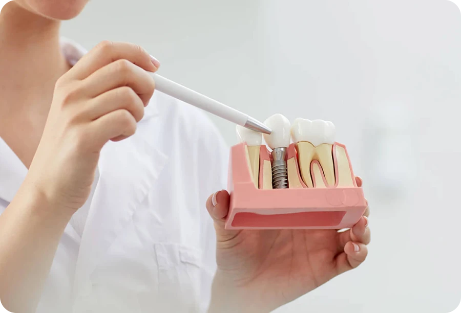 pose implants unitaires alti dent Implant dentaire Cabinet dentaire Alti Dent