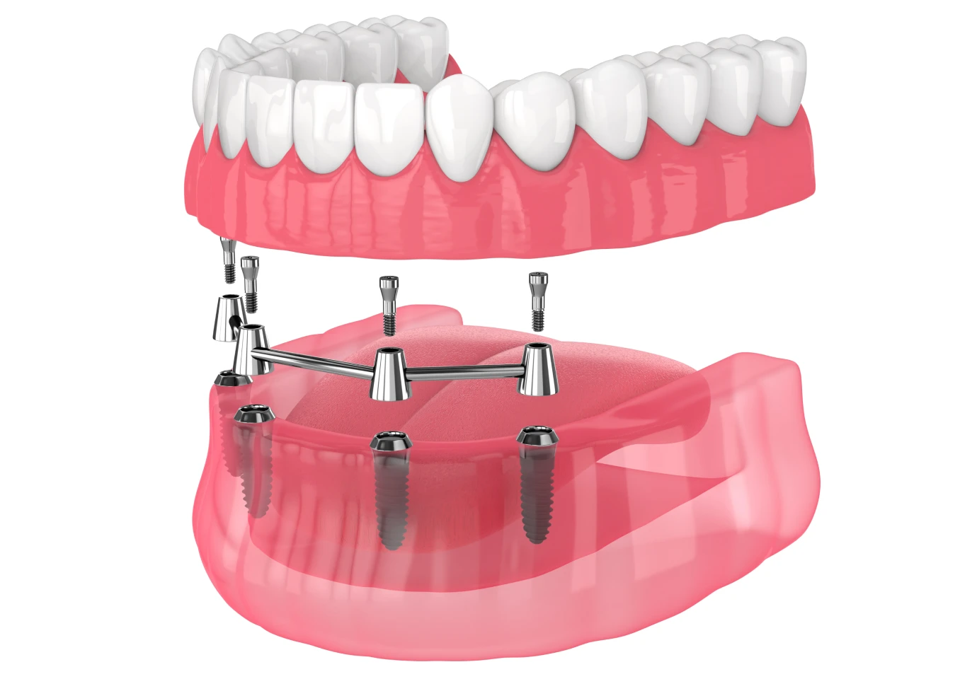 rehabilitation totale alti dent Implant dentaire Cabinet dentaire Alti Dent