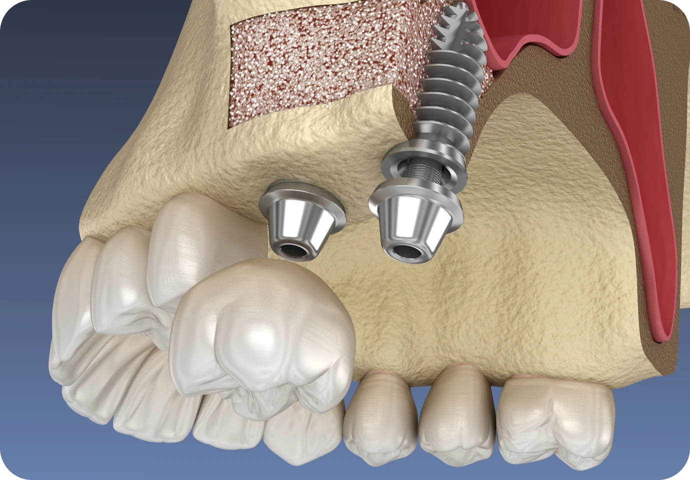 sinus lift alti dent Extraction dentaire Cabinet dentaire Alti Dent