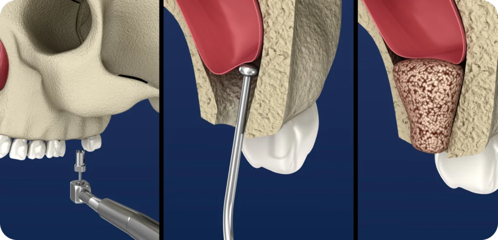 sinus lift cabinet alti dent Sinus lift Cabinet dentaire Alti Dent