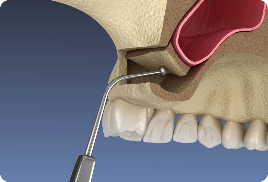 sinus lift docteur lecomte alti dent Sinus lift Cabinet dentaire Alti Dent